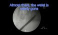 PCNL - Repeated Access/Baloon Failure