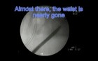 PCNL - Repeated Access/Baloon Failure