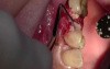 Extraction #13 With Simple Socket Bone Grafting