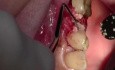 Extraction #13 With Simple Socket Bone Grafting