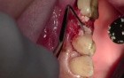 Extraction #13 With Simple Socket Bone Grafting
