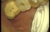 Loading Of Early Prosthesis 16-17-25-26-27 (3/3)