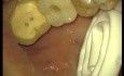 Loading Of Early Prosthesis 16-17-25-26-27 (3/3)