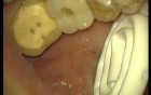 Loading Of Early Prosthesis 16-17-25-26-27 (3/3)