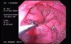 Hyperplastic Gastric Polyp (1 of 3)