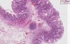 Hyperplastic polyp - Histopathology - Colon