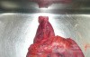Adenocarcinoma of the cardias and gastric fundus with signet-ring cells (8 of 25)