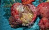 Cancer Ovary Radical Surgery, 2