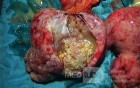 Cancer Ovary Radical Surgery, 2