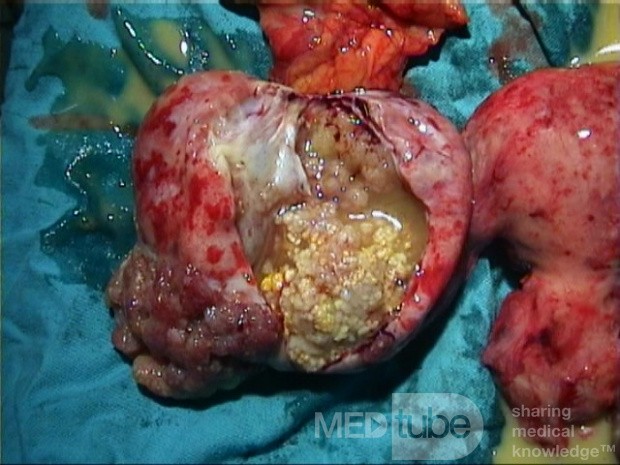 Cancer Ovary Radical Surgery, 2