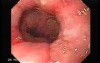 Synchronous Cancer Gastric and Esophageal (5 of 9 )