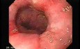 Synchronous Cancer Gastric and Esophageal (5 of 9 )
