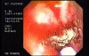 Tubulo - Villous Adenoma - Endoscopy (8 of 28)