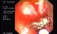 Tubulo - Villous Adenoma - Endoscopy (8 of 28)