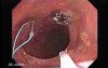 Huge Mass Of The Descending Colon (13 of 25)