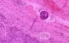 Gallbladder Adenocarcinoma and litiasis (9 of 13)