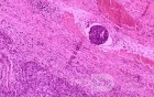 Gallbladder Adenocarcinoma and litiasis (9 of 13)