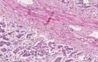 Histopathology Adrenal--Atrophy