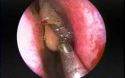 Nasal Polypectomy - Endoscopy 