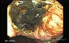 Gastric Cancer - Source of Bleeding