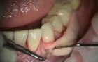 Preprosthetic Soft Tissue Reconstruction
