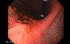 Adenocarcinoma of the Lesser Curvature with Signet Ring Cells (2 of 8)