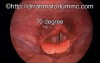Hypopharyngeal and laryngeal inlet