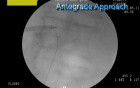 Antegrade Ureterolithotripsy