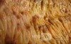 Toxic Dilatation of the Colon Superimposed pseudomembranous colitis involving the
 right colon (13 of 17)