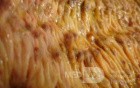 Toxic Dilatation of the Colon Superimposed pseudomembranous colitis involving the
 right colon (13 of 17)