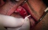 Extractions #11-13 With Simple Socket Bone Grafting, Part Ii