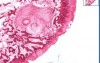 Osteoarthritis - Subchondral Cyst