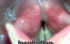 Bilateral and unilateral vocal fold paralysis