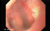 Kissing Duodenal Ulcer