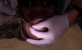 Orthodontic Case #3 Mesialize Maxillary Posterior Segment - Fabricate A Kobayashi Wire/Hook