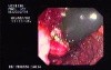 Familial Adenomatous Polyposis of the Colon (9 of 29)