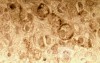Endoscopy of Scirrhous Gastric Carcinoma involving the entire Fundus, Body and the Antrum (8 of 47)