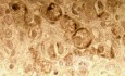 Endoscopy of Scirrhous Gastric Carcinoma involving the entire Fundus, Body and the Antrum (8 of 47)