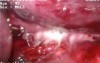 Esophageal perforation - Laparoscopy