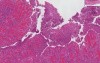 Small Intestine- Crohn Disease