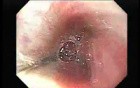 Achalasia Residual Food (3 of 11)