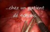 Invaginated Meckel Diverticulum In Laparoscopic View