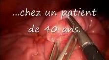 Invaginated Meckel Diverticulum In Laparoscopic View