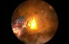 Greenlight HPS - Cutting The Medial Lobe