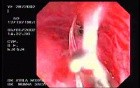 Zollinger- Ellison Syndrome - Gastric Ulcer with Gastrocolic Fistula (11 of 21)