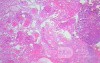 Endoscopic Resection of Giant Tubulo-Villous of the rectum (25 of 35)