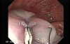Colonoscopic Polypectomy (13 of 23)