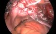 Laparoscopic Sacrocolpoplexy