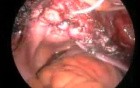 Laparoscopic Sacrocolpoplexy