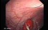 Rectal Stalked Polyp (1 of 7)